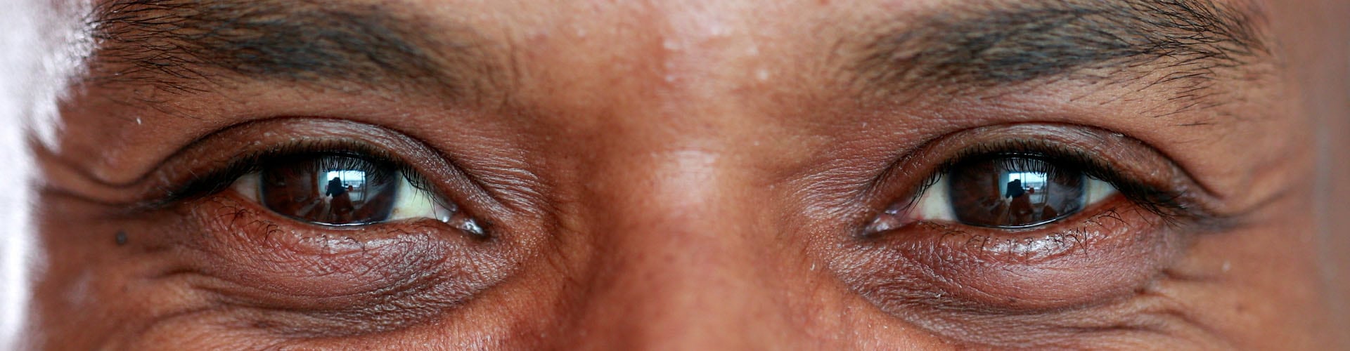 Myopia Control