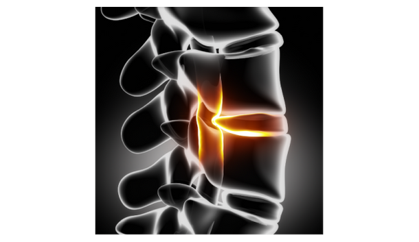 Spinal X-ray illustration showing lumbar disc area