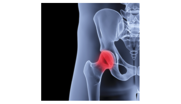 Hip joint X-ray illustration with the femoral head highlighted
