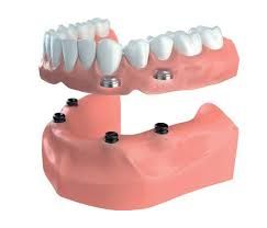Implant-supported crafted at London West Denture Clinic