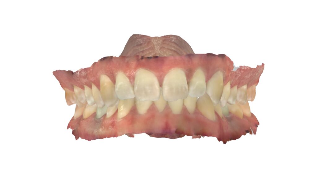 A digital iTero before and after smile scan from West Five Smile Orthodontics