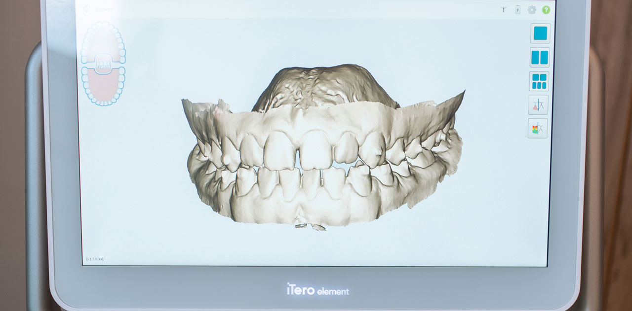 Step 02, 5-minute scan, at West Five Smile Orthodontics
